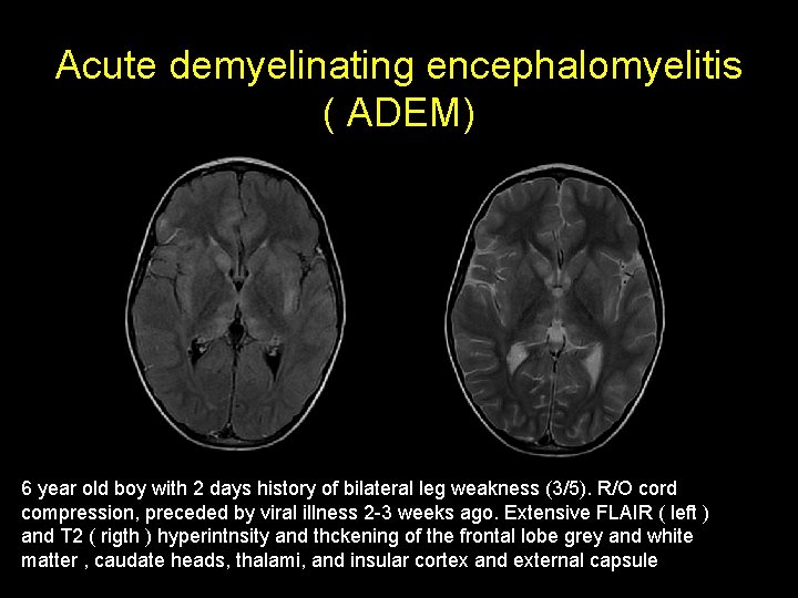 Acute demyelinating encephalomyelitis ( ADEM) 6 year old boy with 2 days history of Acute demyelinating encephalomyelitis ( ADEM) 6 year old boy with 2 days history of