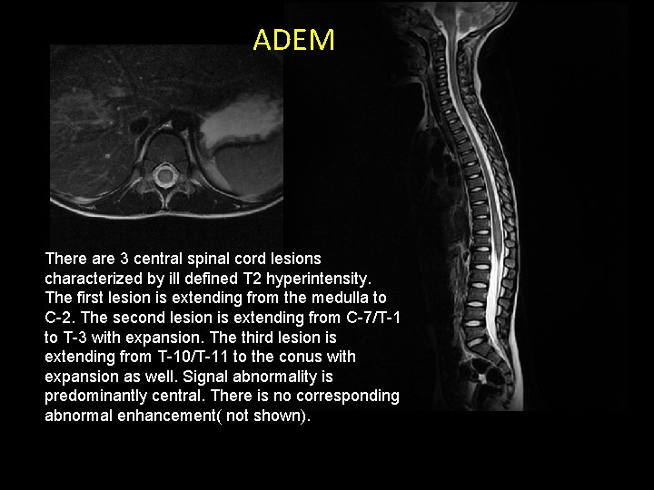 ADEM There are 3 central spinal cord lesions characterized by ill defined T 2 ADEM There are 3 central spinal cord lesions characterized by ill defined T 2