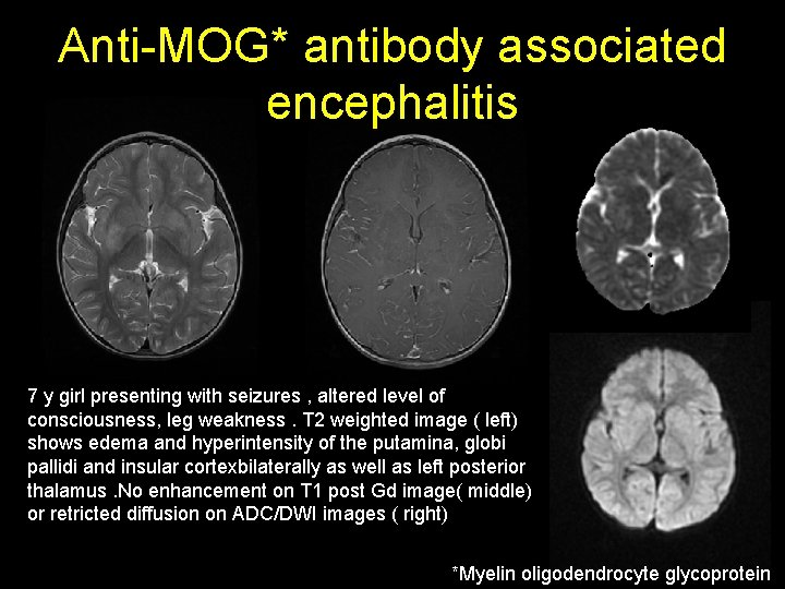 Anti-MOG* antibody associated encephalitis 7 y girl presenting with seizures , altered level of