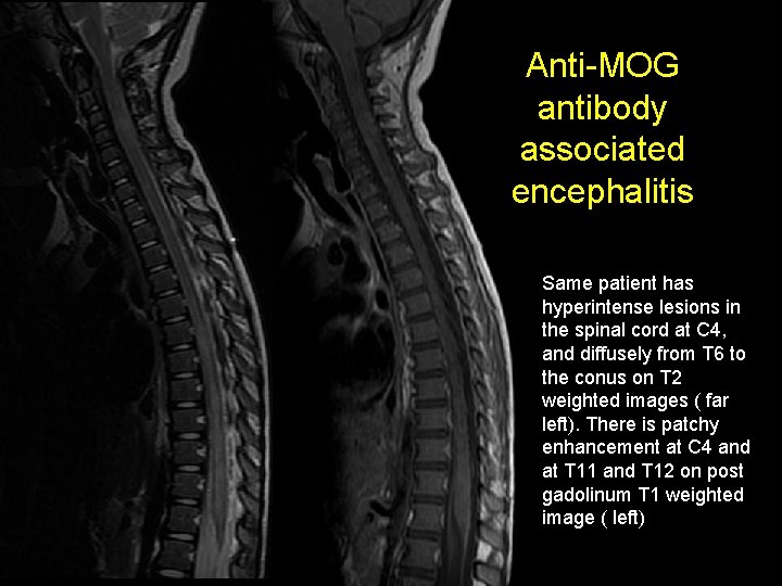 MOG Anti-MOG antibody associated encephalitis Same patient has hyperintense lesions in the spinal cord