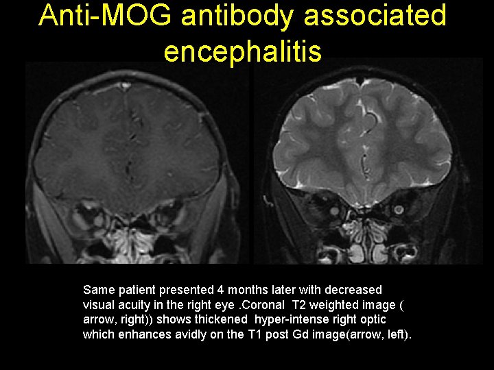 Anti-MOG antibody associated encephalitis Same patient presented 4 months later with decreased visual acuity