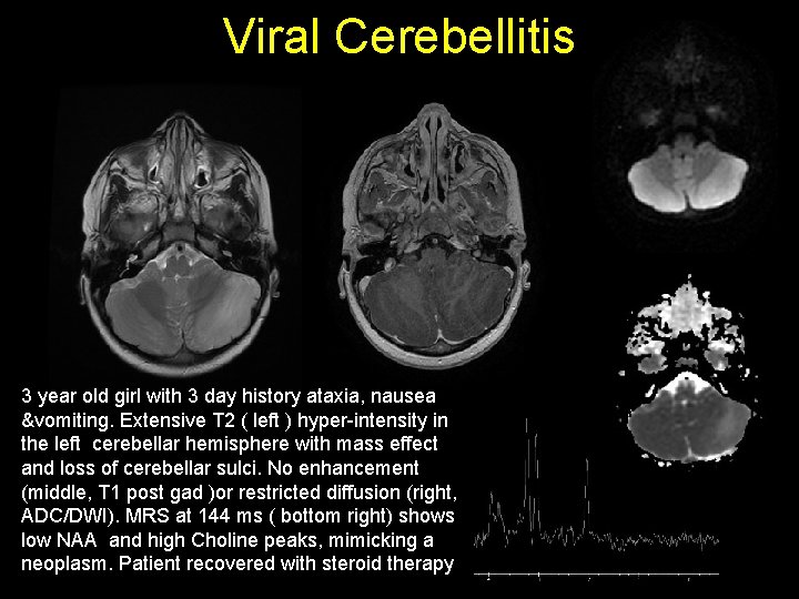 Viral Cerebellitis 3 year old girl with 3 day history ataxia, nausea &vomiting. Extensive