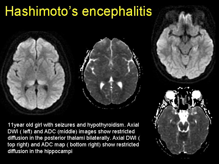 Hashimoto’s encephalitis 11 year old girl with seizures and hypothyroidism. Axial DWI ( left) Hashimoto’s encephalitis 11 year old girl with seizures and hypothyroidism. Axial DWI ( left)