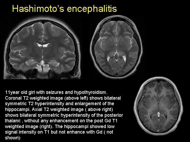 Hashimoto’s encephalitis 11 year old girl with seizures and hypothyroidism. Coronal T 2 weighted Hashimoto’s encephalitis 11 year old girl with seizures and hypothyroidism. Coronal T 2 weighted
