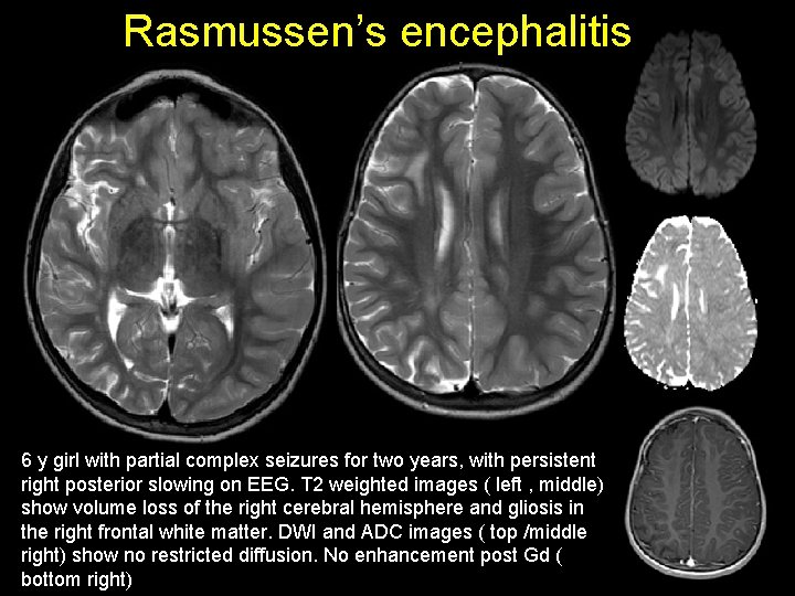 Rasmussen’s encephalitis 6 y girl with partial complex seizures for two years, with persistent Rasmussen’s encephalitis 6 y girl with partial complex seizures for two years, with persistent