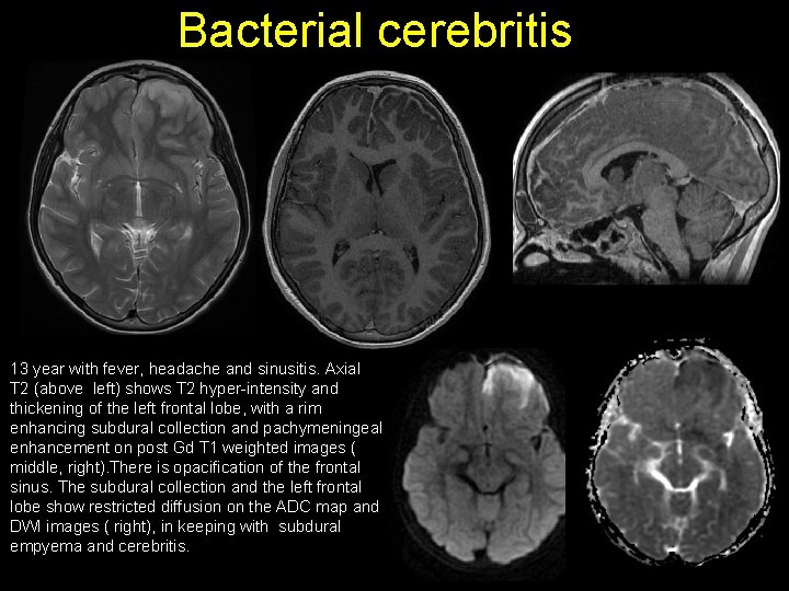 Bacterial cerebritis 13 year with fever, headache and sinusitis. Axial T 2 (above left)