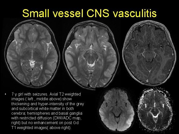 Small vessel CNS vasculitis • 7 y girl with seizures. Axial T 2 weighted