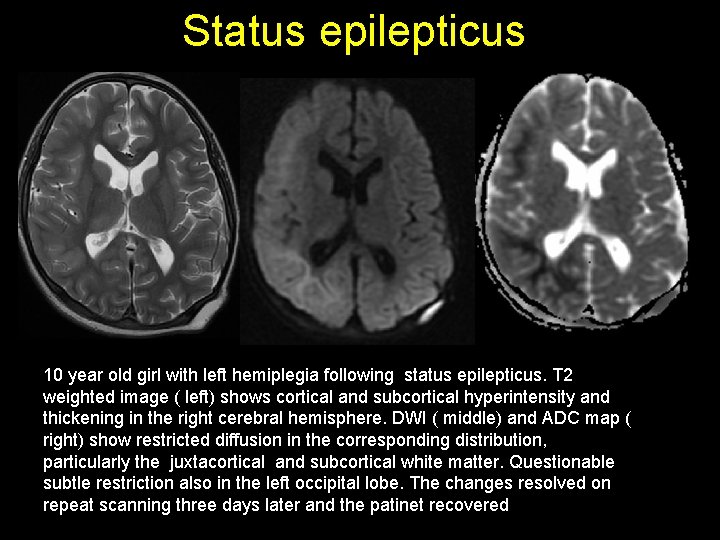 Status epilepticus 10 year old girl with left hemiplegia following status epilepticus. T 2