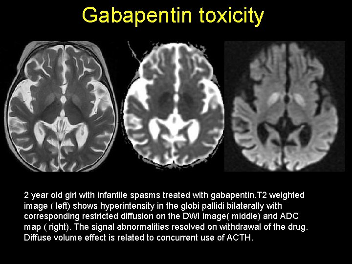 Gabapentin toxicity 2 year old girl with infantile spasms treated with gabapentin. T 2 Gabapentin toxicity 2 year old girl with infantile spasms treated with gabapentin. T 2