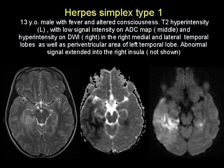 Herpes simplex type 1 13 y. o. male with fever and altered consciousness. T