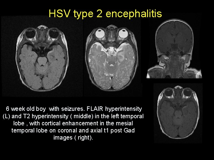 HSV type 2 encephalitis 6 week old boy with seizures. FLAIR hyperintensity (L) and