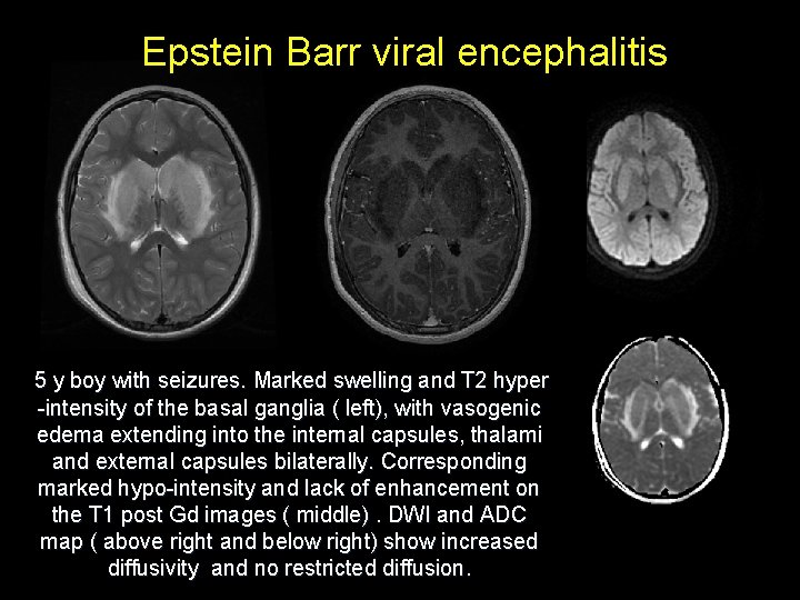 Epstein Barr viral encephalitis 5 y boy with seizures. Marked swelling and T 2 Epstein Barr viral encephalitis 5 y boy with seizures. Marked swelling and T 2