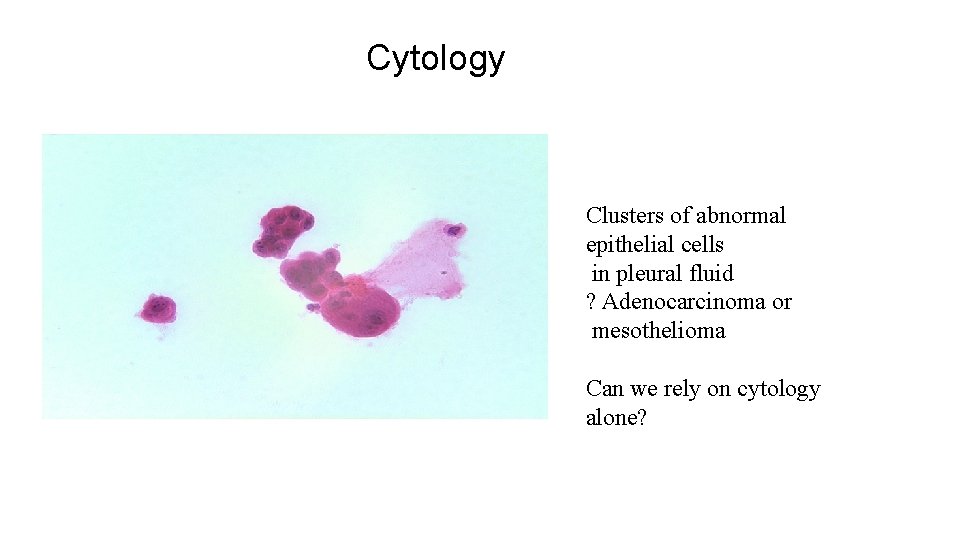 which is worse basal cell squamous cell or melanoma