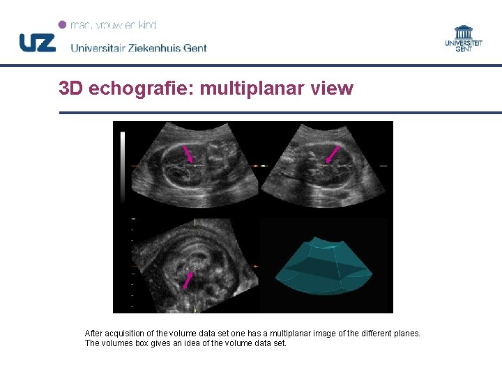 3 D echografie: multiplanar view After acquisition of the volume data set one has