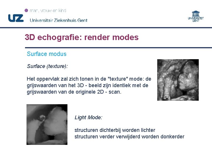 3 D echografie: render modes Surface modus Surface (texture): Het oppervlak zal zich tonen