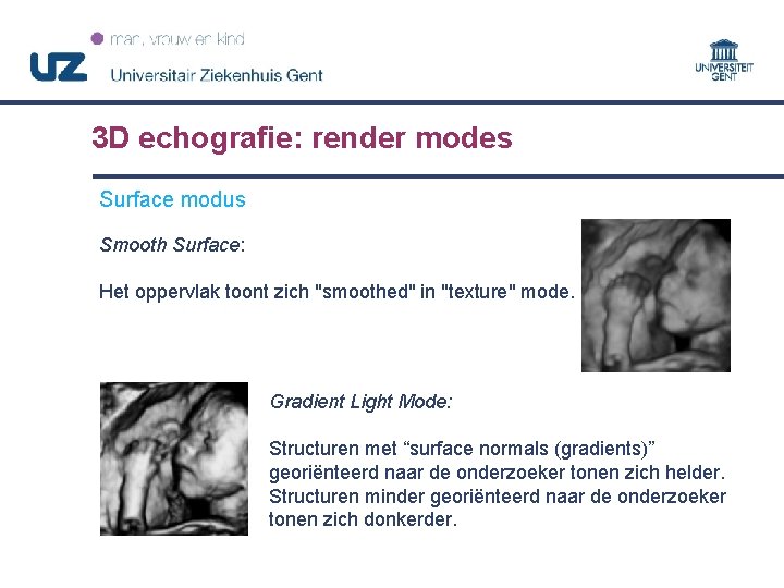 3 D echografie: render modes Surface modus Smooth Surface: Het oppervlak toont zich "smoothed"