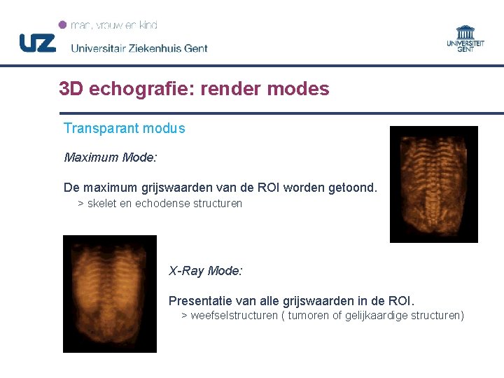 3 D echografie: render modes Transparant modus Maximum Mode: De maximum grijswaarden van de