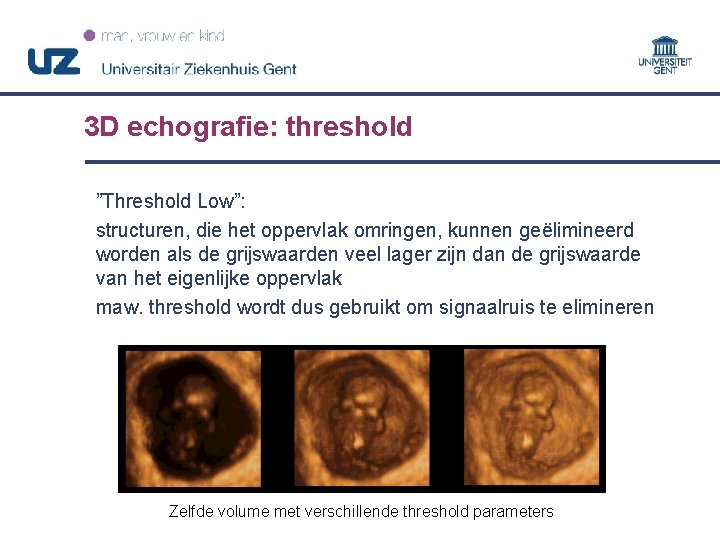3 D echografie: threshold ”Threshold Low”: structuren, die het oppervlak omringen, kunnen geëlimineerd worden