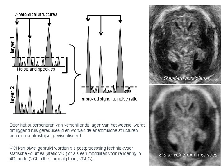 layer 1 Anatomical structures Noise and speckles layer 2 Standard multiplanar Improved signal to