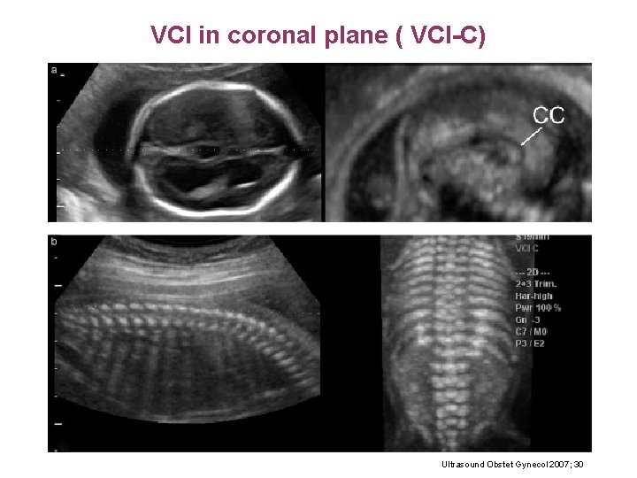 VCI in coronal plane ( VCI-C) Ultrasound Obstet Gynecol 2007; 30 