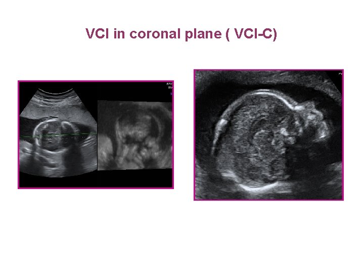 VCI in coronal plane ( VCI-C) 