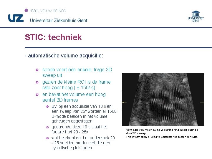 STIC: techniek • automatische volume acquisitie: sonde voert één enkele, trage 3 D sweep