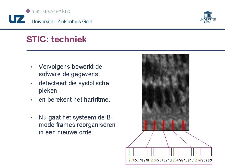 STIC: techniek • • Vervolgens bewerkt de sofware de gegevens, detecteert die systolische pieken