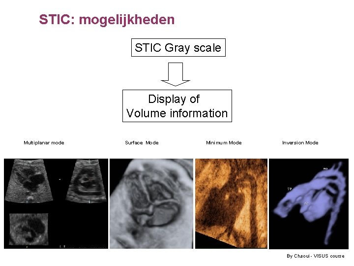 STIC: mogelijkheden STIC Gray scale Display of Volume information Multiplanar mode Surface Mode Minimum