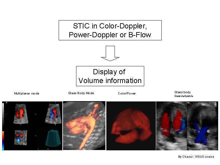 STIC in Color-Doppler, Power-Doppler or B-Flow Display of Volume information Multiplanar mode Glass Body