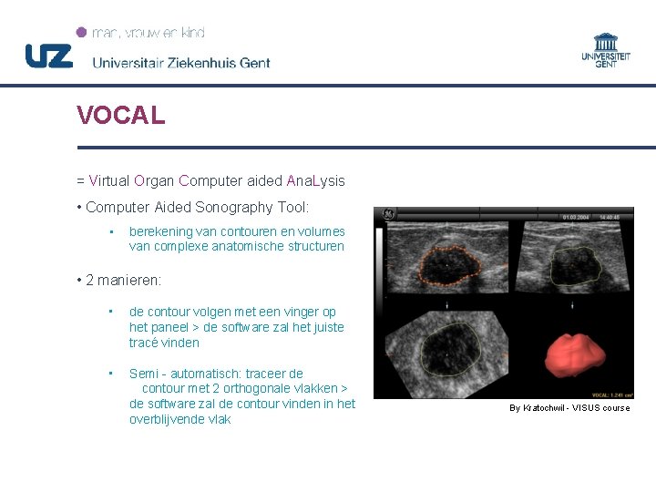 VOCAL = Virtual Organ Computer aided Ana. Lysis • Computer Aided Sonography Tool: •
