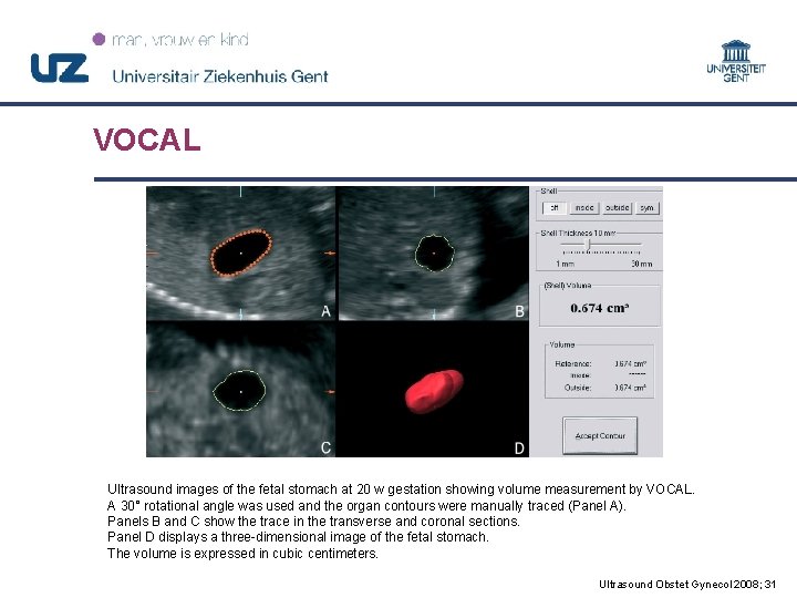 VOCAL Ultrasound images of the fetal stomach at 20 w gestation showing volume measurement