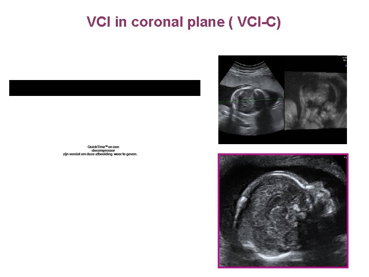 VCI in coronal plane ( VCI-C) 