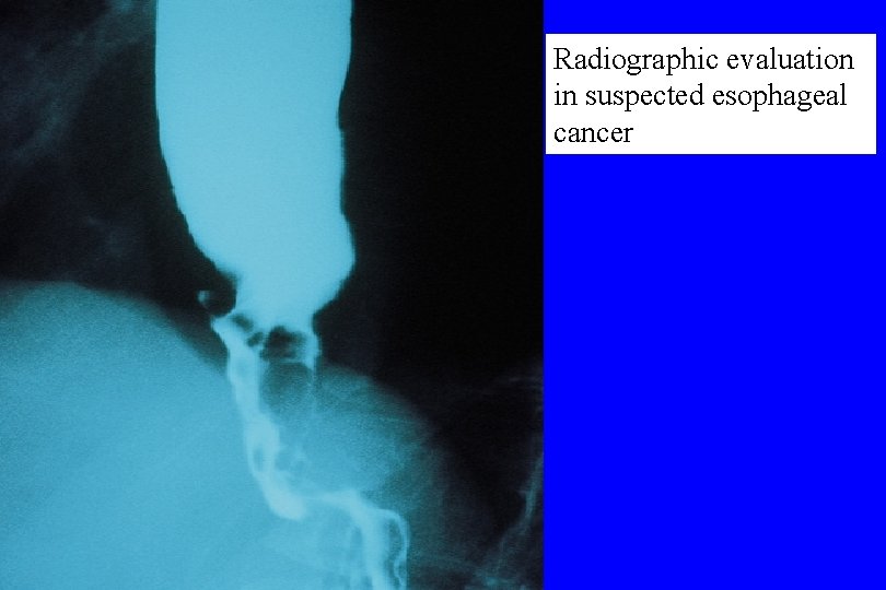 Radiographic evaluation in suspected esophageal cancer 