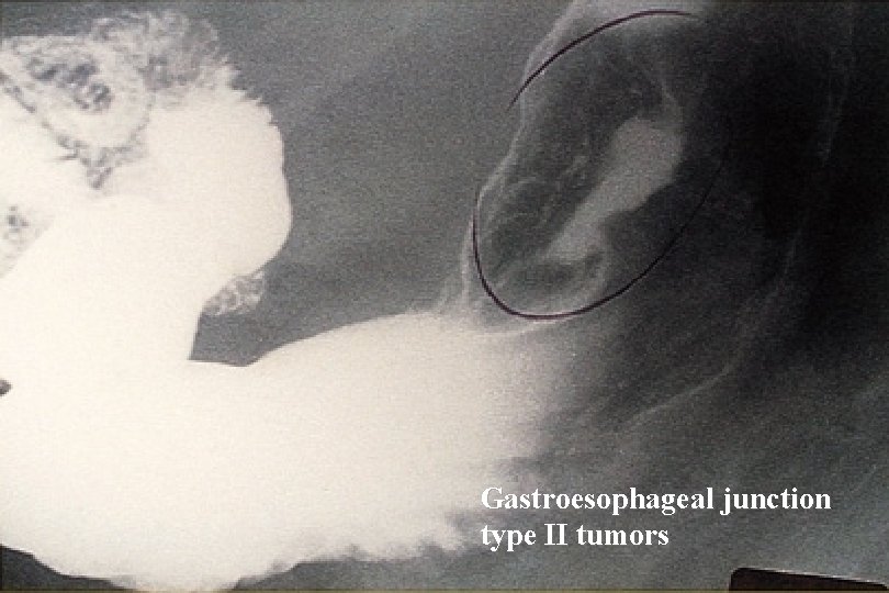 Gastroesophageal junction type II tumors 