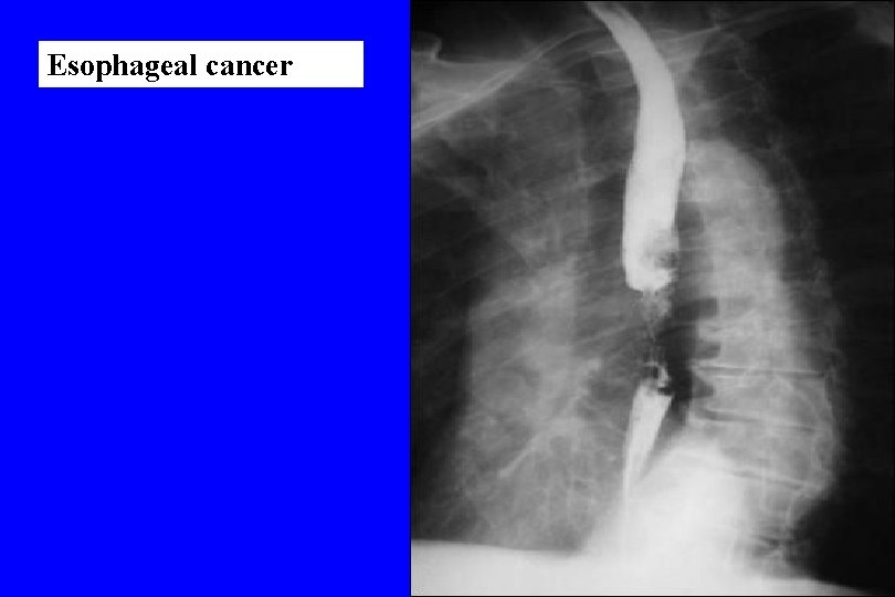 Esophageal cancer 