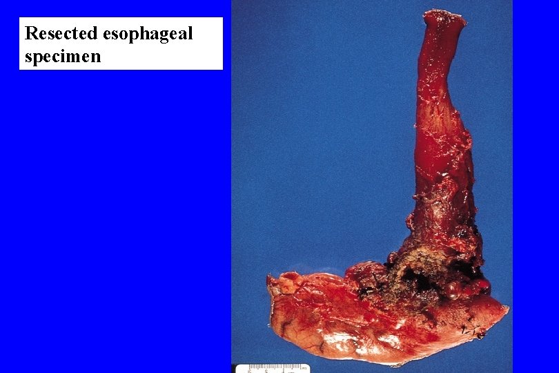 Resected esophageal specimen 