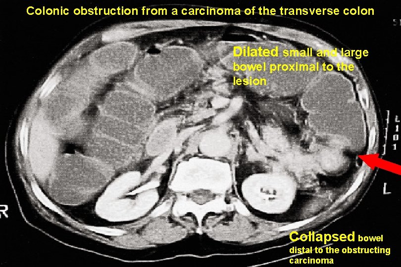 Colonic obstruction from a carcinoma of the transverse colon Dilated small and large bowel