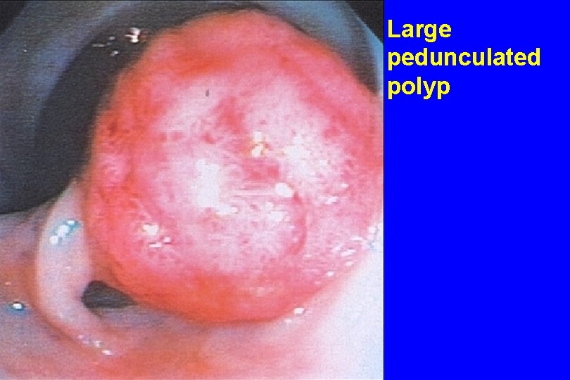 Large pedunculated polyp 