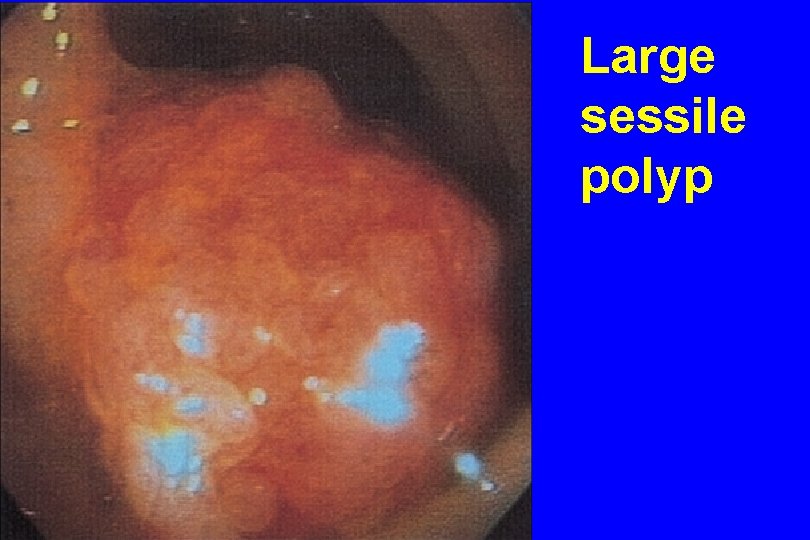 Large sessile polyp 