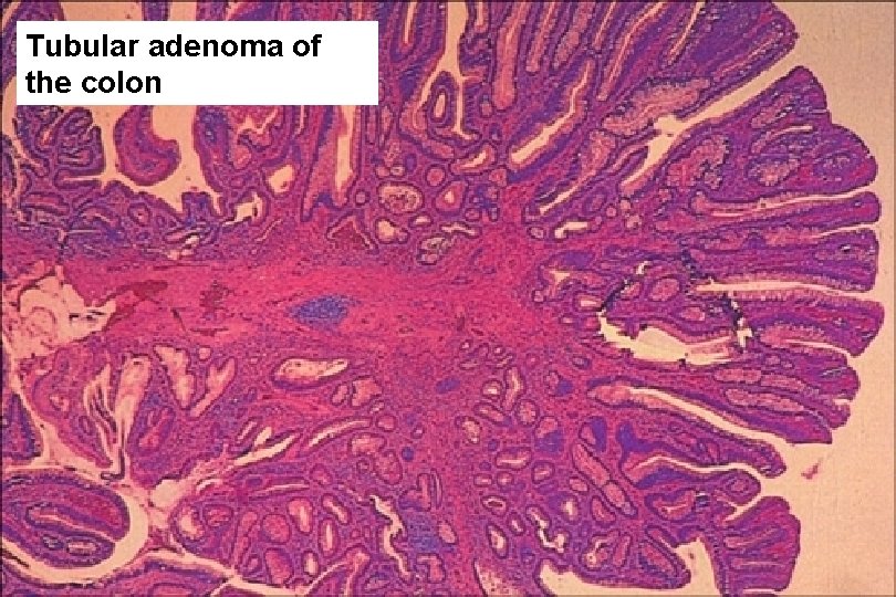 Tubular adenoma of the colon 