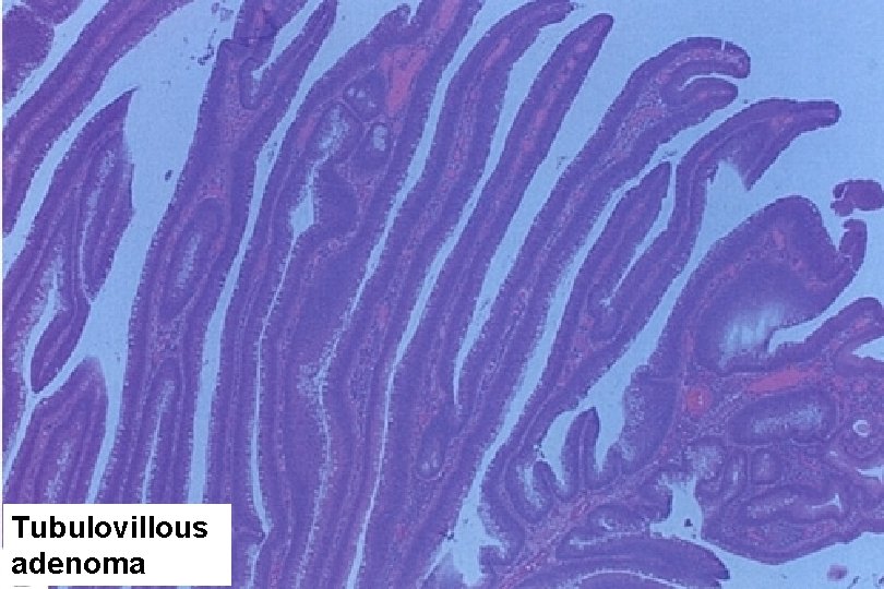 Tubulovillous adenoma 