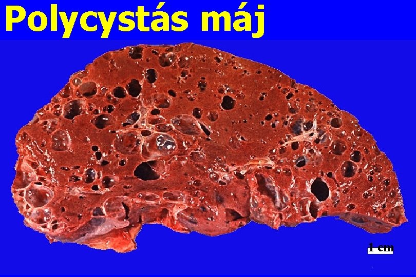 Polycystás máj 1 cm 