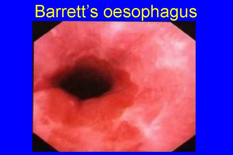 Barrett’s oesophagus 