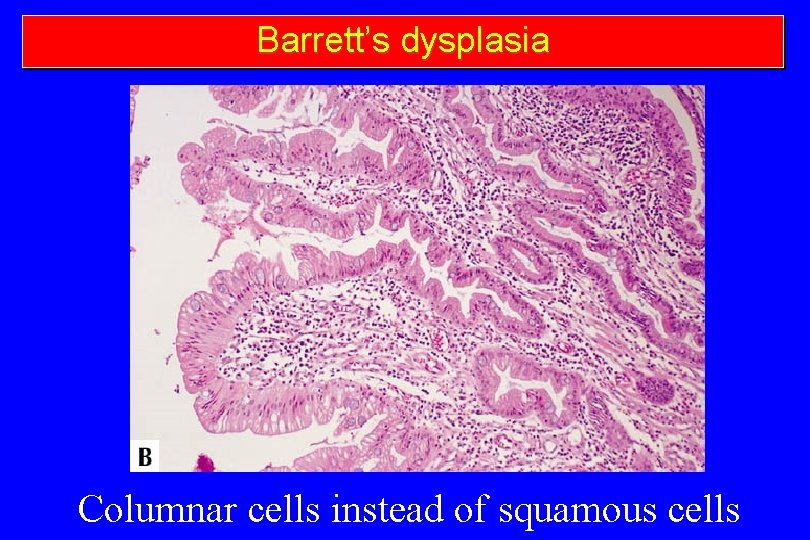 Barrett’s dysplasia Columnar cells instead of squamous cells 