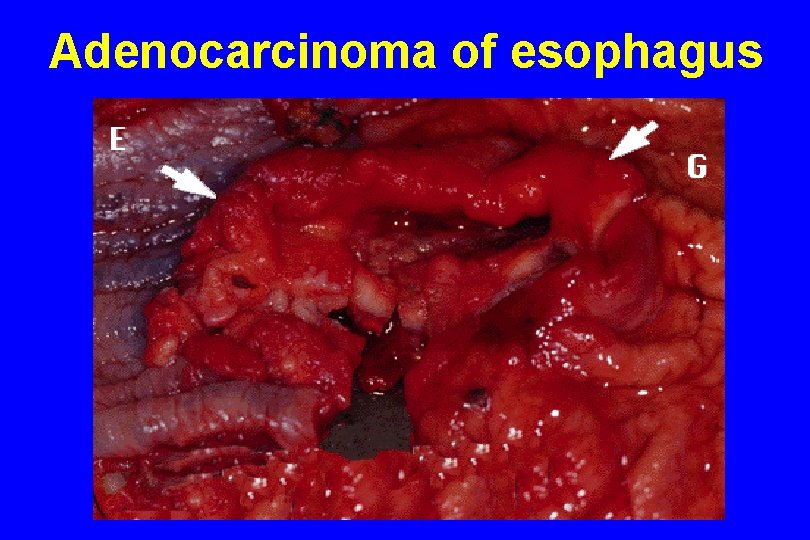 Adenocarcinoma of esophagus 