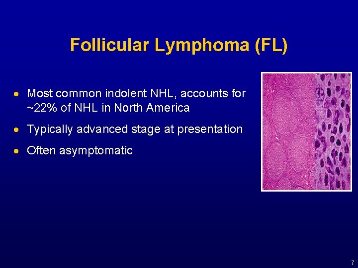 Follicular Lymphoma (FL) · Most common indolent NHL, accounts for ~22% of NHL in