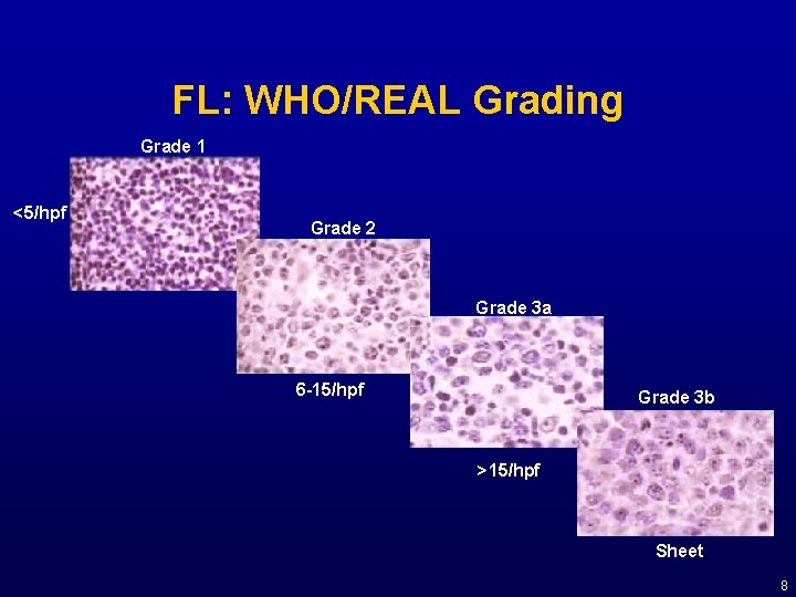 FL: WHO/REAL Grading Grade 1 <5/hpf Grade 2 Grade 3 a 6 -15/hpf Grade