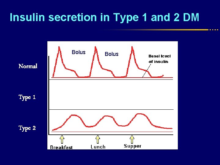 Insulin secretion in Type 1 and 2 DM Prandial Bolus Normal Type 1 Type