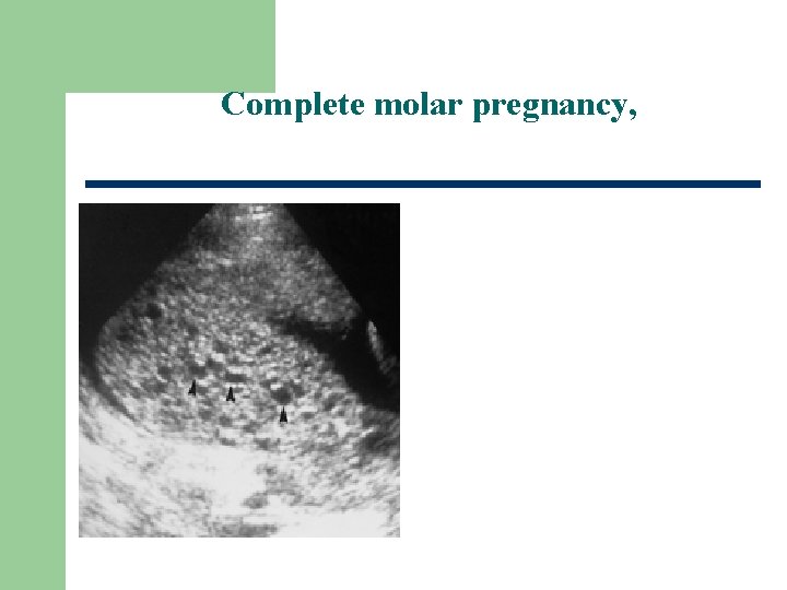 Complete molar pregnancy, 