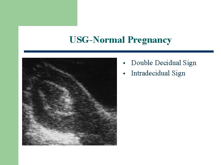 USG-Normal Pregnancy § § Double Decidual Sign Intradecidual Sign 